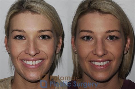 Rhinoplasty - Cosmetic Before & After Photos Patient 200 | Washington DC & Arlington , DC ...