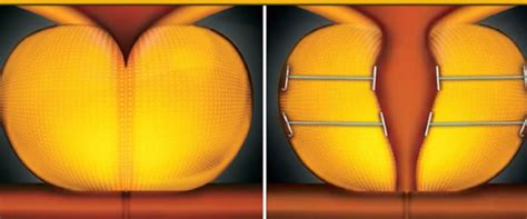 Aster Medcity Performs Kerala’s First UroLift Procedure | Aster Hospitals