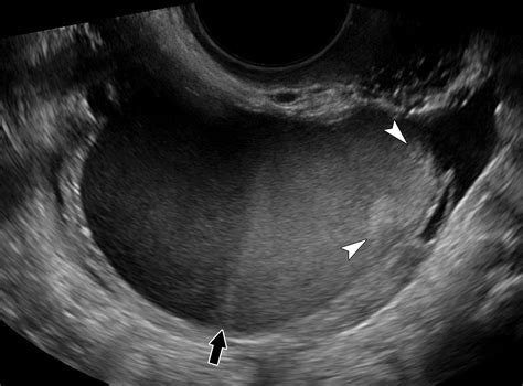 Normal Ovary Ultrasound