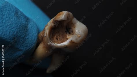 Decayed Tooth Pulling 的图像结果
