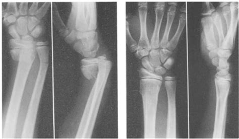 Image result for Extensor Digitorum Communis Surgery