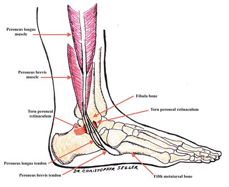 Peroneal Tendon Subluxation - DOC