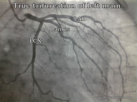 God blesses a few , with a trifurcation of their left main coronary artery ! | Dr.S.Venkatesan MD
