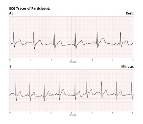 Image result for Pacemaker Programming