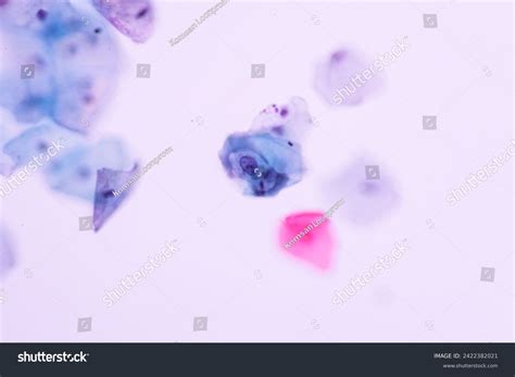 Abnormal Squamous Epithelial Cells View Microscopyhumanpapilloma Stock ...