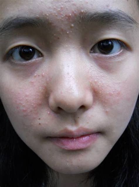 嘴巴一圈长痘痘是什么原因造成的？日常容易忽视的长痘诱因 - 知乎