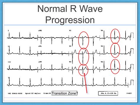 Normal ECG Read Out 的图像结果