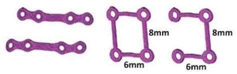 Finite Element Analysis Comparison of Plate Designs in Managing ...