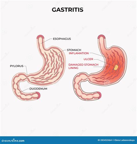 Gastritis Como Inflamación Del Estómago Enfermedad De La Inflamación Del Estómago Diagrama De ...