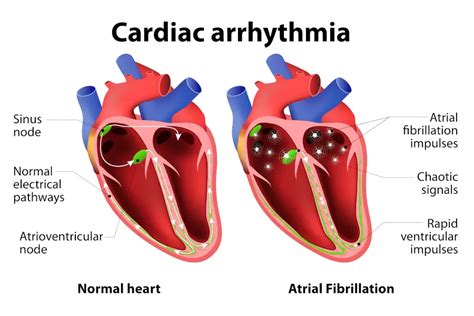 Arrhythmia Definition 的图像结果