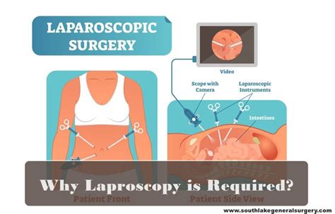 Image result for Laparoscopy Recovery