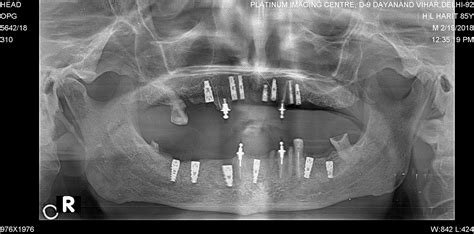 Book Full mouth Dental Implants Services by Dr. Sachet Popli in New ...