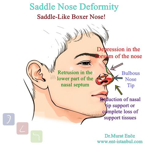 Saddle Nose Deformity