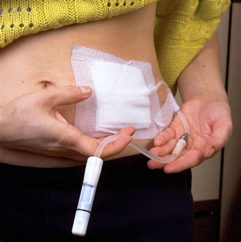 Image result for Capd