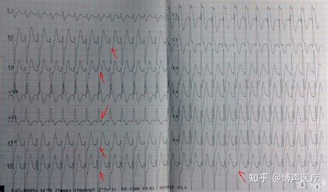 心房颤动与扑动的心电散点图 - 心血管 - 天山医学院