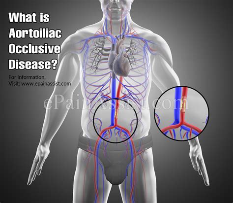 Aortoiliac Occlusive Disease|Causes|Symptoms|Treatment|Prevention|Diagnosis