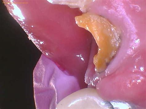 Image result for Root Extraction Tooth Broken Off