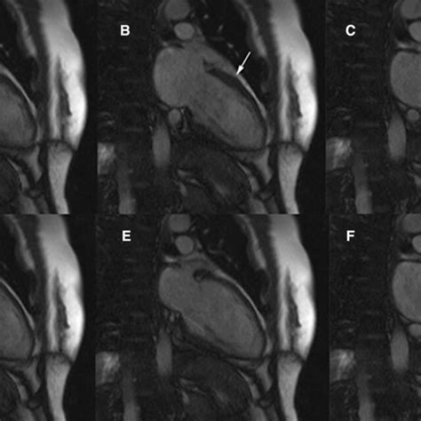 Image result for PVC Localization