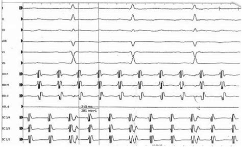 Image result for Counterclockwise Atrial Flutter