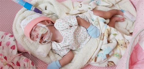 A Trisomy 18 Journey – Grace Chiinsankim Guite (1 months 23 days old)on ...
