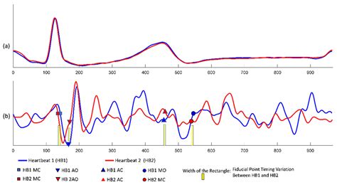 Computer-Aided Detection of Fiducial Points in Seismocardiography ...