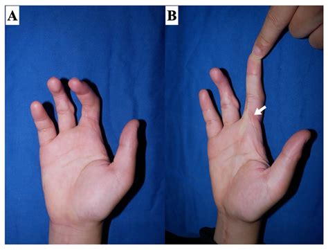 Management of Scar Contractures of the Hand—Our Therapeutic Strategy ...