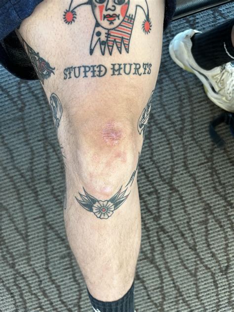 Keloid Scarring Tattoos