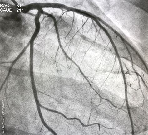 Coronary Angiogram Procedure 的图像结果