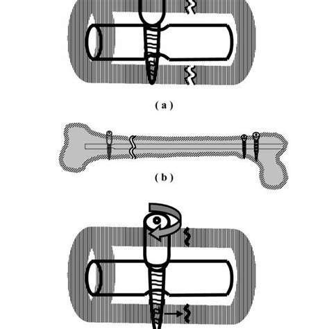 Image result for Dynamic Axial Compression