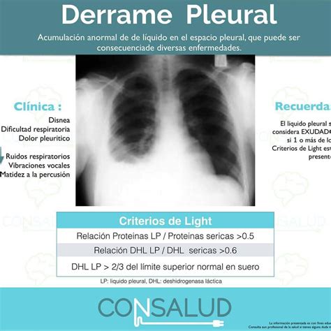 Derrame Pleural: Causas, Síntomas Y Tratamiento – YTIQ