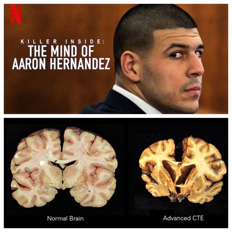 CTE Brain 的图像结果