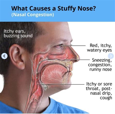 오늘도 한 걸음 더: “나 코 막혔어” 영어로? - 유머/움짤/이슈 - 에펨코리아