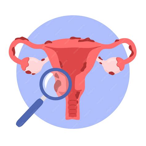 Premium Vector | Illustration of the uterus and endometriosis. womens diseases, gynecological ...