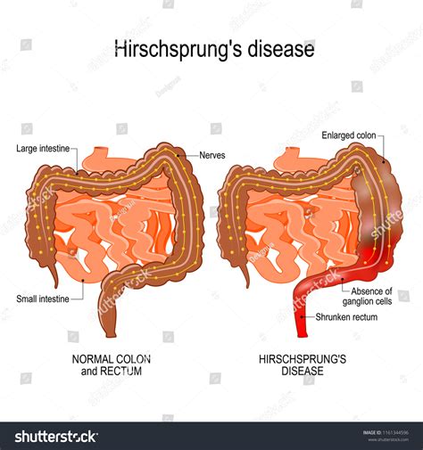 Ribbon Like Stools Hirschsprungs Disease