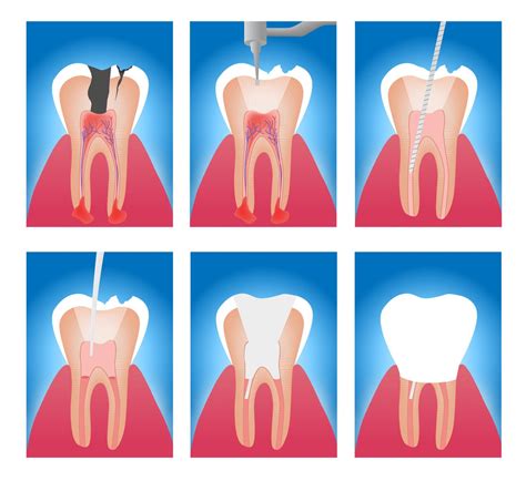 Services – Endodontics of the Ozarks
