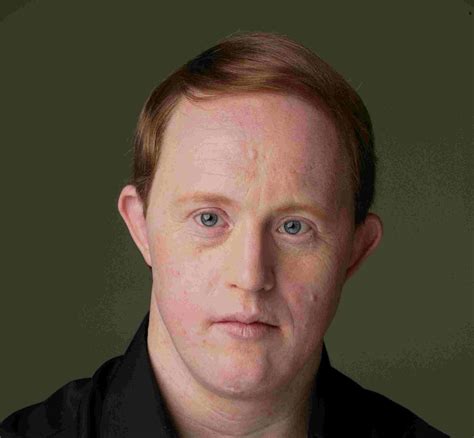 Celebrities with Down Syndrome - Maple Services
