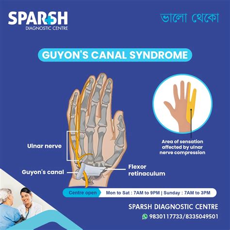 Guyon’s Canal Syndrome: Causes, Symptoms, Diagnosis, and Treatment - Sparsh Diagnostic Center