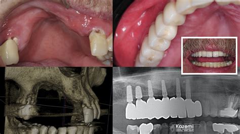 Dental Bone Regrowth at Debra Millender blog
