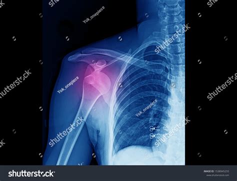 Dislocated Right Shoulder X Ray
