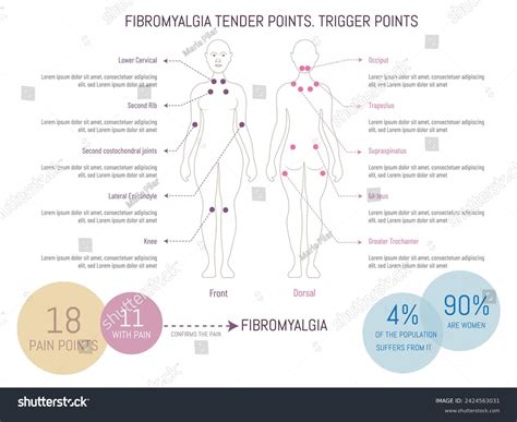Infographic Most Sensitive Points Fibromyalgia Trigger Stock Vector ...