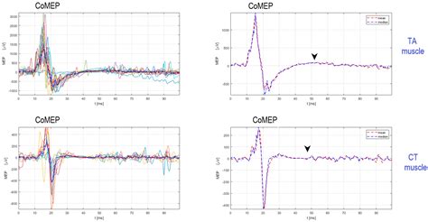 Exploring Neurophysiological Mechanisms and Treatment Efficacies in ...