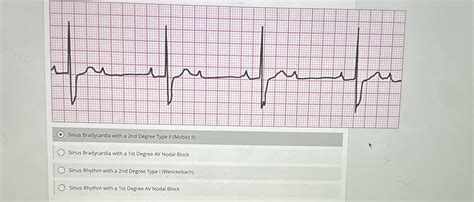Solved Sinus Bradycardia with a 2nd Degree Type II (Mobitz | Chegg.com
