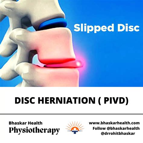 Slip Disc Physiotherapy Treatment at Paige Odriscoll blog