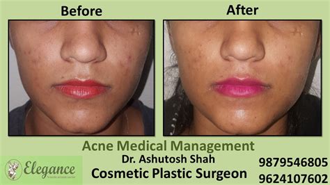 Acne Medication, DAMAN, Gujarat, India.