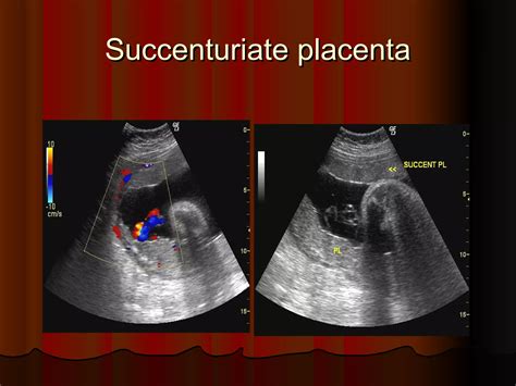 Anterior Placenta Ultrasound