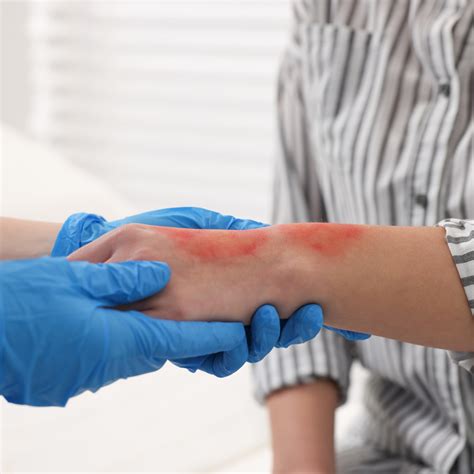 Burns First Aid – What You Need to Know | Executive Training