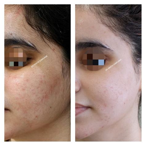 https://www.dermatologydiaries.com/wp-content/uploads/2021/01/Acne-removal-treatment-in-Mumbai-pigmentation-removal-treatment-before-and-after-results-1024x1024.jpg