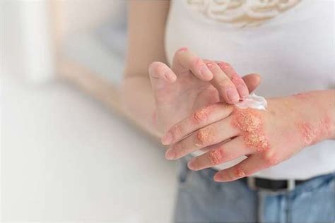 Mycosis (Fungal Infection): Causes, Symptoms & Treatment