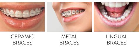 Teeth Braces Cost In Japan at Humberto Watts blog