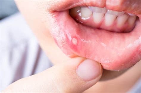 Ayurvedic Oral Ulcer & Infection Relief | Natural Mouth Healing ...